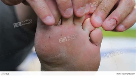 Man Discovers Itchy Athletes Foot Growth On Toes Stock Video Footage