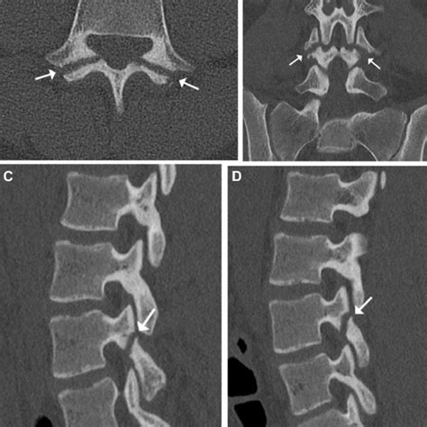 Right Sided Pars Interarticularis Defect At L3 Closed Arrow On