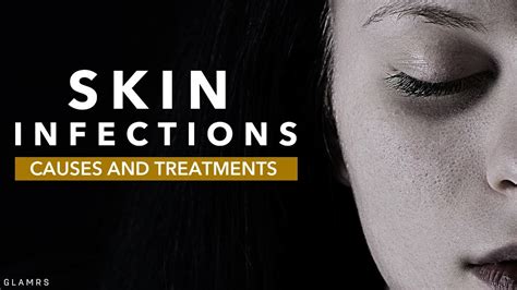Skin Infections Causes And Treatments Youtube