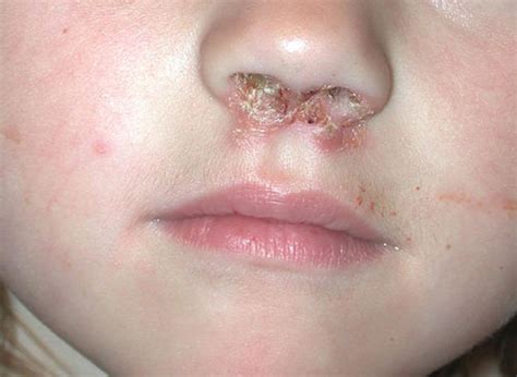 Impetigo What To Know About This Common Skin Infection In Children
