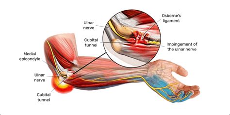 Ulnar Nerve Entrapment Cubital Tunnel Syndrome USASC Orthopedics