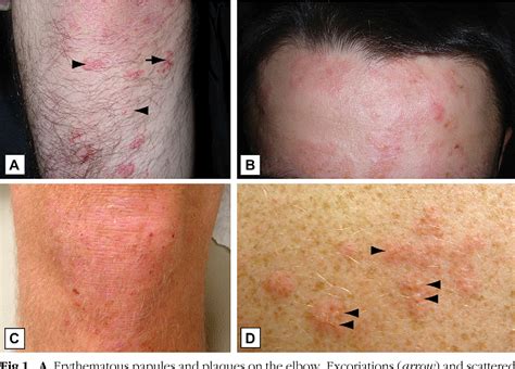 Figure From Dermatitis Herpetiformis Part I Epidemiology Pathogenesis And Clinical