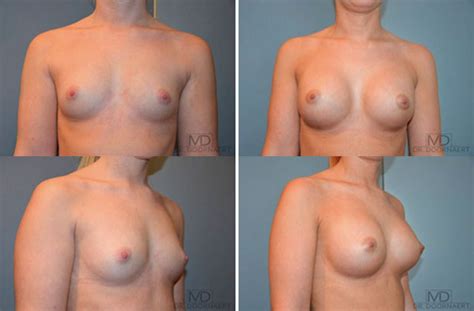 Body Feminization Surgery Brustvergrößerung 2pass Clinic