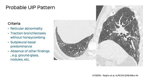 Case 6 Probable Usual Interstitial Pneumonia Probable Uip Ipf