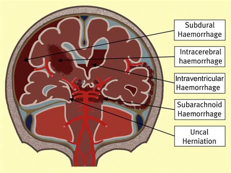 Spontaneous Intracranial Haemorrhage Surgery Oxford International