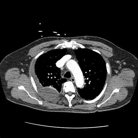 Pleural effusion occurs when too much fluid collects in the pleural space (the space between the two layers of the pleura). Loculated Pleural Effusion Diagram / Loculated pleural effusion | Radiology, Anatomy and ...