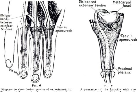 Figure 7 From Recurrent Dislocation Of Extensor Tendons In The Hand