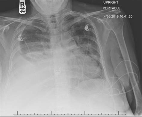 Southwest Journal Of Pulmonary Critical Care And Sleep Imaging