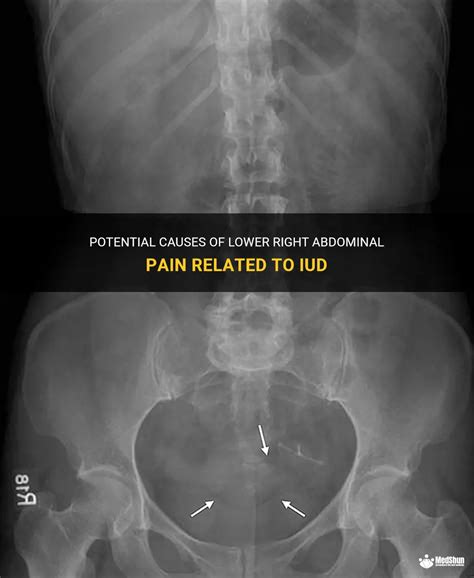 Potential Causes Of Lower Right Abdominal Pain Related To Iud Medshun