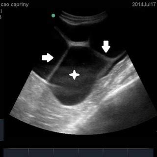 Ultrassonografia De Tero Com Mucometra Trab Culas M Veis Setas