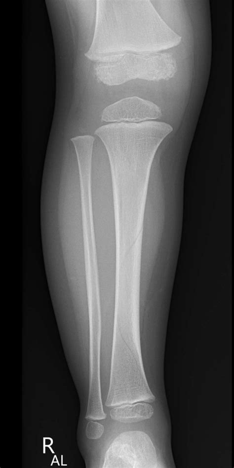 Toddlers Fracture Image