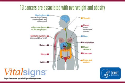 Cancers Associated With Overweight And Obesity Make Up 40 Percent Of Cancers Diagnosed In The