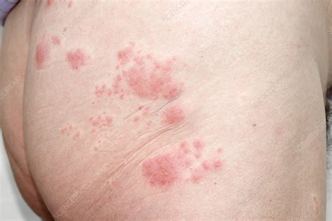 Shingles Rash On The Buttock Stock Image C Science Photo Library
