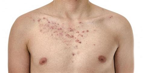 How To Get Rid Of Chest Acne 10 Natural Remedies