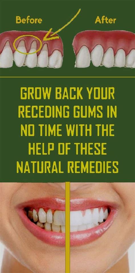 Pin By Pashakuybedin On Health In 2020 Receding Gums Natural