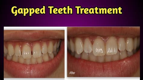 Gapped Teeth Causes And Treatment Youtube