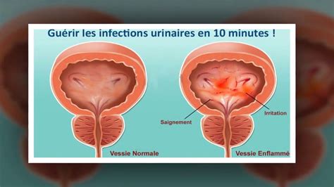 Remède 100% naturel pour traiter les infections urinaires – Un seul