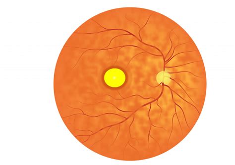 Adult Vitelliform Macular Degeneration Ucl Institute Of Ophthalmology