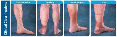 Leg Discoloration Stasis Dermatitis Health Life Media