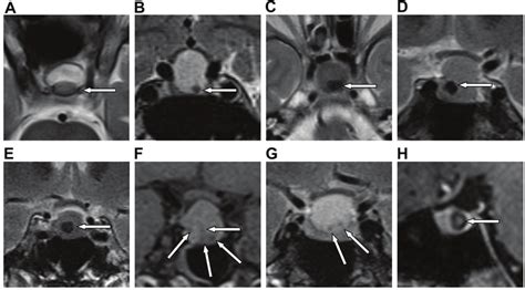 Rcc Intracystic Nodules Observed Using Mri Case Numbers Correspond