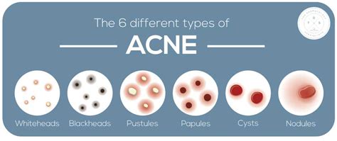 Types Of Acne And How To Treat Them Eleven11 Spa