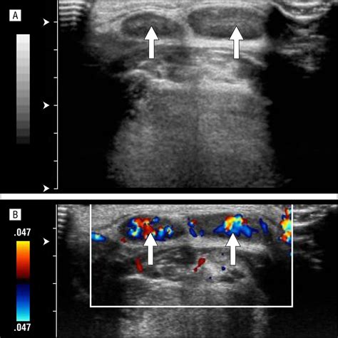 Ultrasonography In The Treatment Of A Pediatric Midline Neck Mass