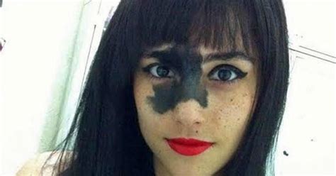 This Girls Rare Birthmark Looks Bizarre To People But She Proved That