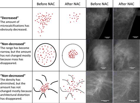 Do Decreased Breast Microcalcifications After Neoadjuvant Chemotherapy Predict Pathologic