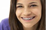 Перевод контекст braces c английский на русский от reverso context: Braces - Straighter Teeth For A Wider Smile - Dr Smile