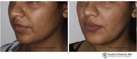 Sculpting The Face With Buccal Fat Reduction