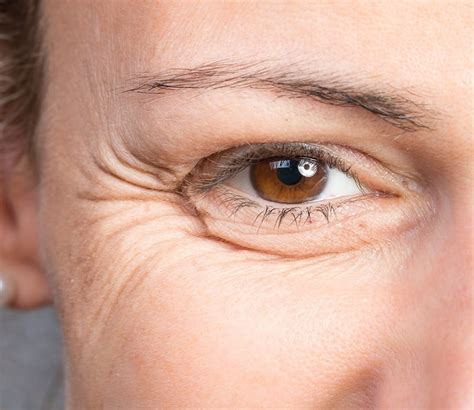 Skin Concern Crows Feet Wrinkles The London Skin Clinic