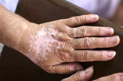 Study Finds Multiple New Disease Associations With Vitiligo