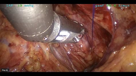 Laparoscopic Paravaginal Repair And Uterosacral Ligament Suspension