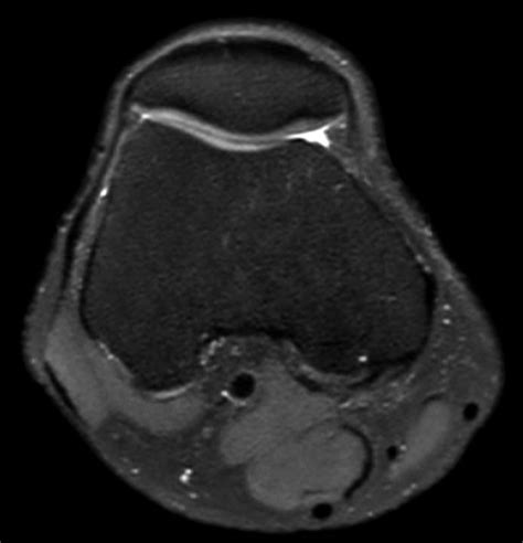 Comprehensive D Knee Imaging With Msk View Philips Mr Body Map
