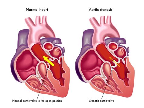 Hidden Burden Of Severe Aortic Stenosis Far Exceeds Current Nhs Capacity