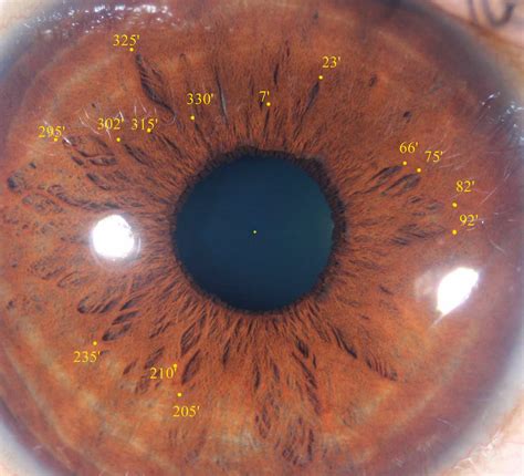 Modern And Multidimensional Iridology The Inner Pupillary Border