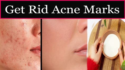 How To Get Rid Acne Marks How To Get Rid Dark Spots Permanently How