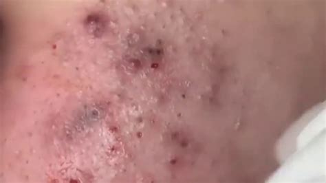 How To Remove Blackheads And Whiteheads On Face L Pimple Popping 2019 L