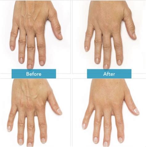 Your Hands Can Often Reveal Your Age At Laser Clinique We Offer