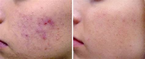 Find The Best Acne Laser Treatment Near You Top Clinics