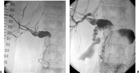 43 Stenting Malignant Biliary Obstruction Radiology Key