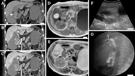 Figure1radiographic Images Of The Extrahepatic Bile Duct Tumor A C