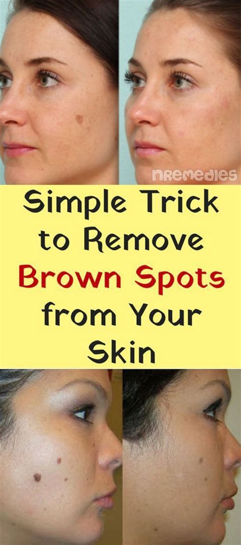 Simple Trick To Remove Brown Spots From Your Skin Spots On Face