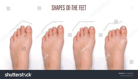 Types Foot Shape Toe Shape Foto Stock Editar Agora 1914683032