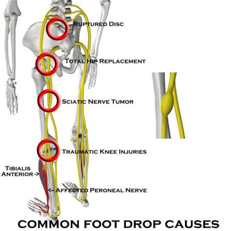 Treating With Foot Drop Almawi Limited The Holistic Clinic