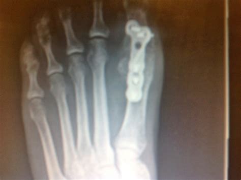 Seek broken toe nhs treatment if your toe has suffered an open fracture, if it is bleeding, or has an odd sensation such as pins and needles or numbness. Foot and Ankle Problems By Dr. Richard Blake: Wednesday's ...