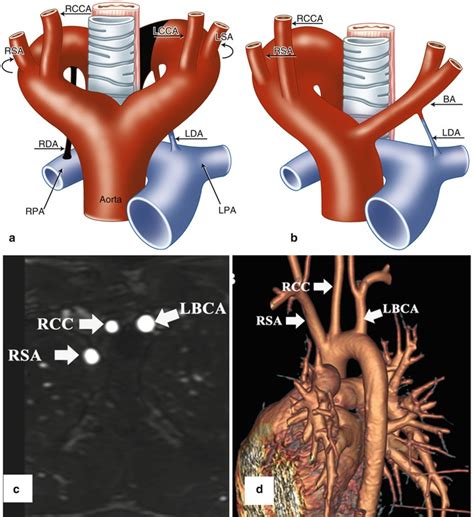 The Differential Diagnosis Of Double Aortic Arch And