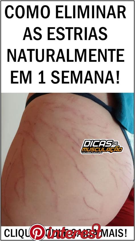 Como Eliminar As Estrias Naturalmente Em Semana Como Eliminar As