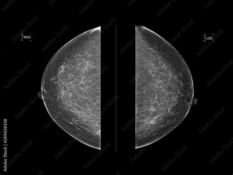 Mammogram Or Mammography Show Normal Healthy Human Breast Mammogram