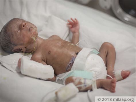 16 Day Old Baby Born With A Hole In His Stomach Can Only Feed Milaap